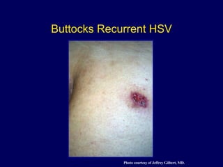 Buttocks Recurrent HSV Photo courtesy of Jeffrey Gilbert, MD. 