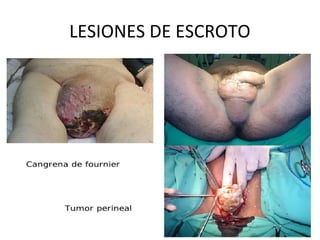 LESIONES DE ESCROTO
 