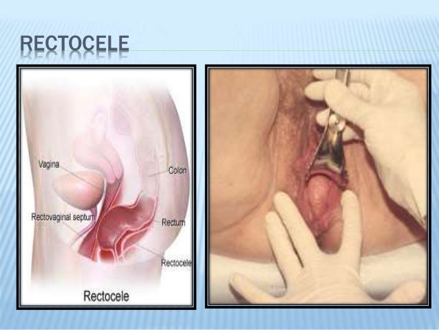 prolaps af uterus efter fødslen anal rengøring prolaps af uterus efter fødslen anal rengøring