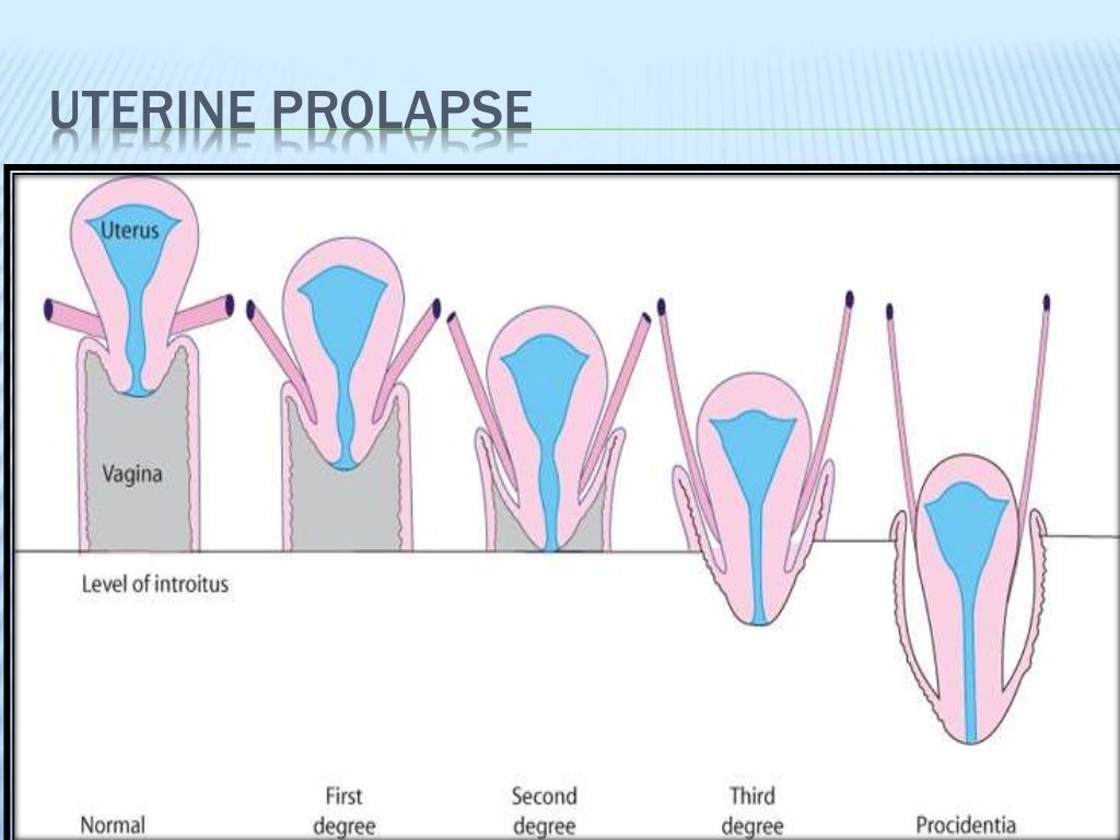 Types Of Bladder Prolapse At Nathan Mcnicholas Blog Types Of Bladder Prolapse At Nathan Mcnicholas Blog