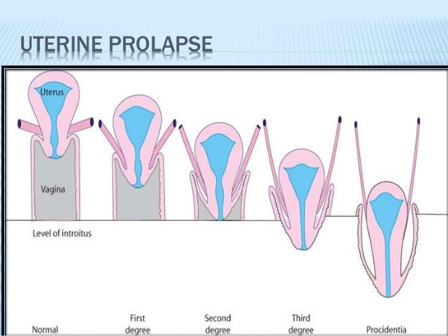 Genital prolapse