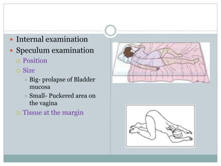  Internal examination
 Speculum examination
 Position
 Size
 Big- prolapse of Bladder
mucosa
 Small- Puckered area on
the vagina
 Tissue at the margin
 