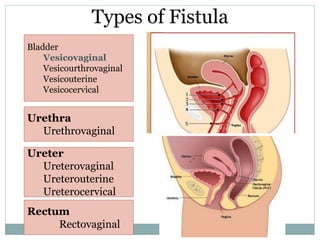 Types of Fistula
Bladder
Vesicovaginal
Vesicourthrovaginal
Vesicouterine
Vesicocervical
Urethra
Urethrovaginal
Ureter
Ureterovaginal
Ureterouterine
Ureterocervical
Rectum
Rectovaginal
 