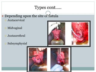 Types cont…..
 Depending upon the site of fistula
 Juxtacervical
 Midvaginal
 Juxtaurethral
 Subsymphysial
 