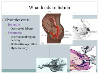 What leads to fistula
 Obstetrics cause
 Ischemic
 Obstructed labour
 Traumatic
 Instrumental vaginal
delivery
 Destructive operation
 Hysterectomy
 