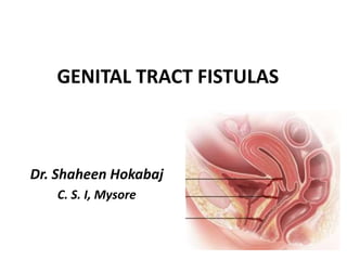 GENITAL TRACT FISTULAS
Dr. Shaheen Hokabaj
C. S. I, Mysore
 