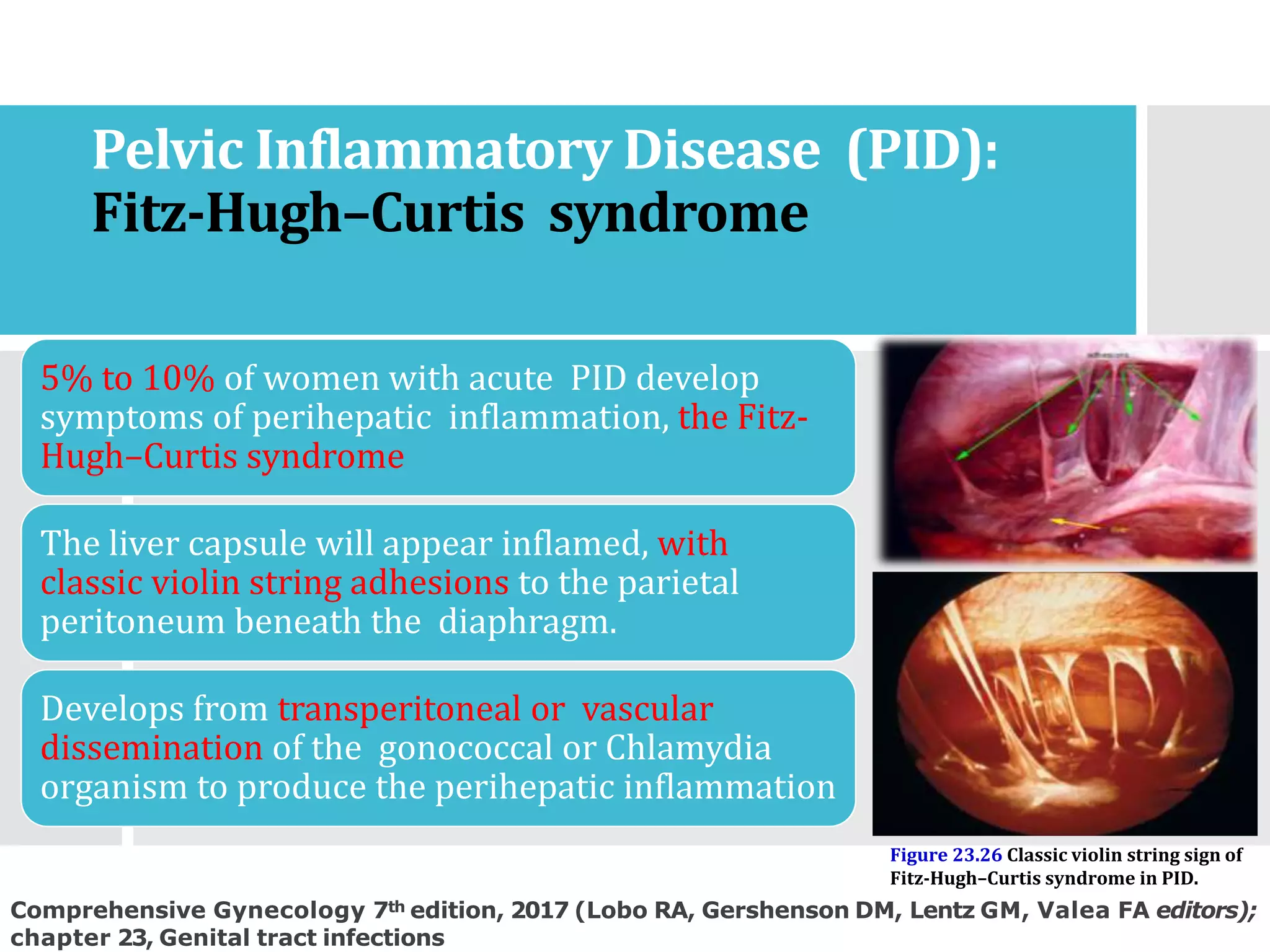String. Sign Fitz genital tract infections.pptx