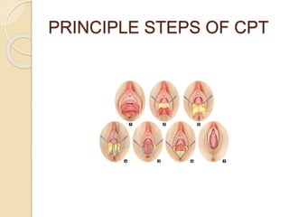 PRINCIPLE STEPS OF CPT
 
