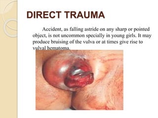 DIRECT TRAUMA
Accident, as falling astride on any sharp or pointed
object, is not uncommon specially in young girls. It may
produce bruising of the vulva or at times give rise to
vulval hematoma.
 