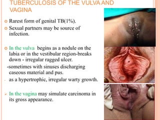 TUBERCULOSIS OF THE VULVA AND
VAGINA
 Rarest form of genital TB(1%).
 Sexual partners may be source of
infection.
 In the vulva begins as a nodule on the
labia or in the vestibular region-breaks
down - irregular ragged ulcer.
-sometimes with sinuses discharging
caseous material and pus.
- as a hypertrophic, irregular warty growth.
 In the vagina may simulate carcinoma in
its gross appearance.
 