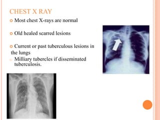 CHEST X RAY
 Most chest X-rays are normal
 Old healed scarred lesions
 Current or past tuberculous lesions in
the lungs
o Milliary tubercles if disseminated
tuberculosis.
 