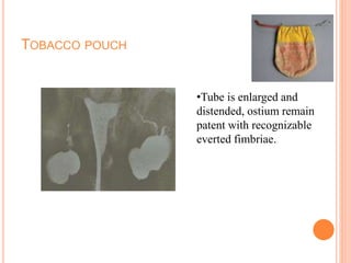 TOBACCO POUCH
•Tube is enlarged and
distended, ostium remain
patent with recognizable
everted fimbriae.
 