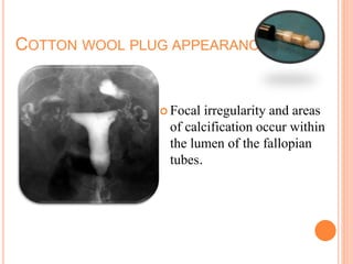 COTTON WOOL PLUG APPEARANCE..
 Focal irregularity and areas
of calcification occur within
the lumen of the fallopian
tubes.
 
