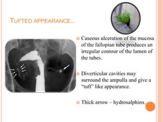 TUFTED APPEARANCE..
 Caseous ulceration of the mucosa
of the fallopian tube produces an
irregular contour of the lumen of
the tubes.
 Diverticular cavities may
surround the ampulla and give a
“tuft” like appearance.
 Thick arrow – hydrosalphinx.
 