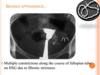 BEADED APPEARANCE..
 Multiple constrictions along the course of fallopian tube
on HSG due to fibrotic strictures.
 