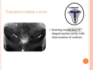 T-SHAPED UTERINE CAVITY
 Scarring results in a “T”
shaped uterine cavity with
intravasation of contrast.
 