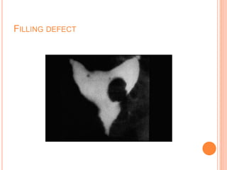 FILLING DEFECT
 