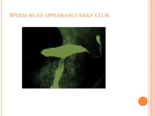 SPERM HEAD APPEARANCE/GOLF CLUB
 
