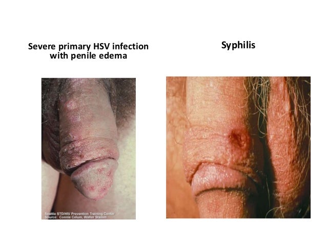 Common Symptoms of Genital Herpes in Men and Women