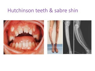 Hutchinson teeth & sabre shin
 