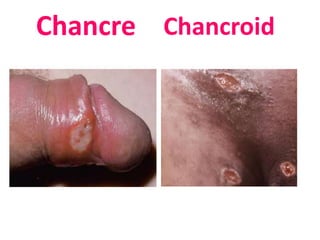 Chancre Chancroid
 