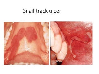 Snail track ulcer
 
