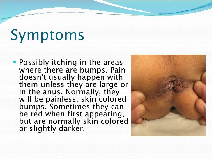 Genital Warts (HPV) Picture Image on MedicineNet.com