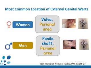 Most Common Location of External Genital Warts
Women
Vulva,
Perianal
area
Men
Penile
shaft,
Perianal
area
Ref: Journal of Women’s Health 2004. 13:265-271
 