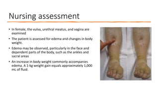 Nursing assessment
• In female, the vulva, urethral meatus, and vagina are
examined
• The patient is assessed for edema and changes in body
weight.
• Edema may be observed, particularly in the face and
dependent parts of the body, such as the ankles and
sacral areas
• An increase in body weight commonly accompanies
edema. A 1-kg weight gain equals approximately 1,000
mL of ﬂuid.
 