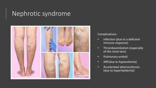Nephrotic syndrome
Complications-
• Infection (due to a deﬁcient
immune response)
• Thromboembolism (especially
of the renal vein)
• Pulmonary emboli
• ARF(due to hypovolemia)
• Accelerated atherosclerosis
(due to hyperlipidemia)
 