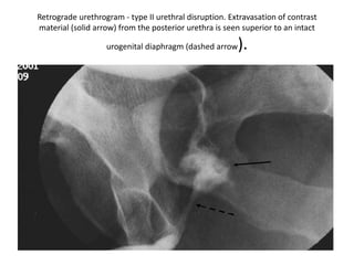 Genito-urinary trauma | PPT