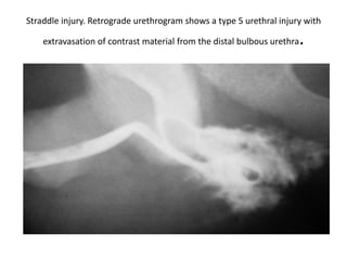 Trauma Urethrogram Genito-urinary trauma | PPT