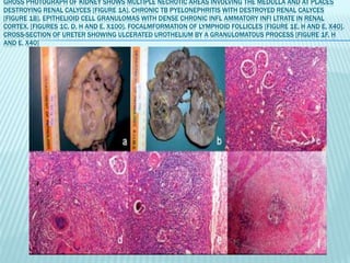 GROSS PHOTOGRAPH OF KIDNEY SHOWS MULTIPLE NECROTIC AREAS INVOLVING THE MEDULLA AND AT PLACES
DESTROYING RENAL CALYCES [FIGURE 1A]. CHRONIC TB PYELONEPHRITIS WITH DESTROYED RENAL CALYCES
[FIGURE 1B]. EPITHELIOID CELL GRANULOMAS WITH DENSE CHRONIC INFL AMMATORY INFI LTRATE IN RENAL
CORTEX. [FIGURES 1C, D, H AND E, X100]. FOCALMFORMATION OF LYMPHOID FOLLICLES [FIGURE 1E, H AND E, X40].
CROSS-SECTION OF URETER SHOWING ULCERATED UROTHELIUM BY A GRANULOMATOUS PROCESS [FIGURE 1F, H
AND E, X40]
 