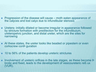  Progression of the disease will cause – moth eaten appearance of
the calyces and lost calyx due to infundibular stenosis
 Ureters- initially dilated or become irregular in appearance followed
by stricture formation with predilection for the infundibulum,
ureteropelvic junction, and distal ureter, which are the sites for
narrowing
 At these states, the ureter looks like beaded or pipestem or even
corkscrew conÞ guration
 10 to 56% of the patients develop ureteric strictures
 Involvement of ureteric orifices in the late stages, as these become Þ
brotic and fixed, leads to the development of vesicoureteric reß ux
(VUR).
 