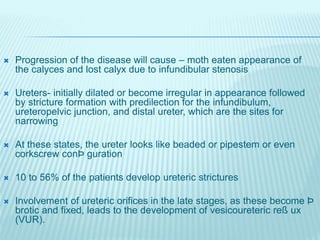  Progression of the disease will cause – moth eaten appearance of
the calyces and lost calyx due to infundibular stenosis...
