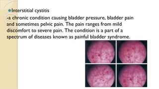 ⚫Interstitial cystitis
-a chronic condition causing bladder pressure, bladder pain
and sometimes pelvic pain. The pain ranges from mild
discomfort to severe pain. The condition is a part of a
spectrum of diseases known as painful bladder syndrome.
 