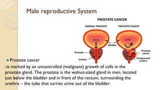 Male reproductive System
⚫ Prostate cancer
-is marked by an uncontrolled (malignant) growth of cells in the
prostate gland. The prostate is the walnut-sized gland in men, located
just below the bladder and in front of the rectum, surrounding the
urethra – the tube that carries urine out of the bladder.
 