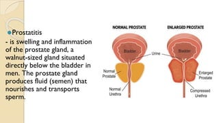 ⚫Prostatitis
- is swelling and inflammation
of the prostate gland, a
walnut-sized gland situated
directly below the bladder in
men. The prostate gland
produces fluid (semen) that
nourishes and transports
sperm.
 