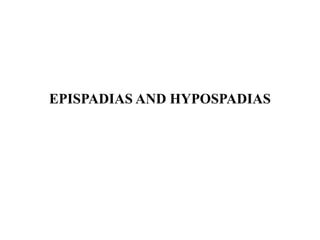 EPISPADIAS AND HYPOSPADIAS
 
