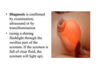 • Diagnosis is confirmed
by examination,
ultrasound or by
transillumination
• (using a shining
flashlight through the
swollen part of the
scrotum. If the scrotum is
full of clear fluid, the
scrotum will light up).
 