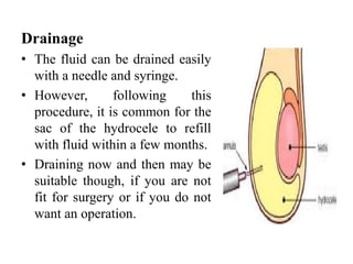 Drainage
• The fluid can be drained easily
with a needle and syringe.
• However, following this
procedure, it is common for the
sac of the hydrocele to refill
with fluid within a few months.
• Draining now and then may be
suitable though, if you are not
fit for surgery or if you do not
want an operation.
 