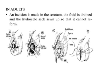 IN ADULTS
• An incision is made in the scrotum, the fluid is drained
and the hydrocele sack sewn up so that it cannot re-
form.
 
