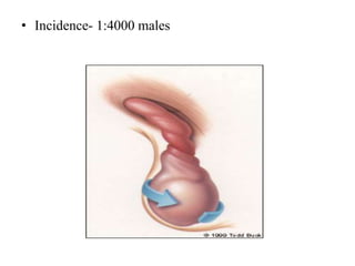 • Incidence- 1:4000 males
 