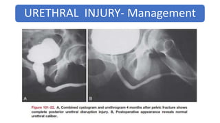 Trauma Urethrogram Trauma to Urinary Tract/ Urinary Tract Injury | PPTX
