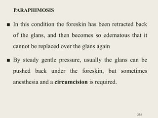 PARAPHIMOSIS
■ In this condition the foreskin has been retracted back
of the glans, and then becomes so edematous that it
cannot be replaced over the glans again
■ By steady gentle pressure, usually the glans can be
pushed back under the foreskin, but sometimes
anesthesia and a circumcision is required.
235
 
