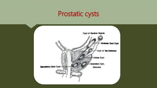 Prostatic cysts