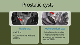 Prostatic cysts
Utricle cyst
- Midline.
- Communicate with the
urethra.
Müllerian duct cyst.
- Extend above the prostate
•- M.B lateral to the midline.
•- They do not communicate
with the urethra