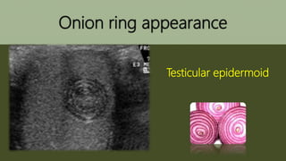 Onion ring appearance
Testicular epidermoid