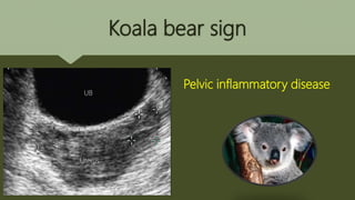 Koala bear sign
Pelvic inflammatory disease
Uterus
UB
