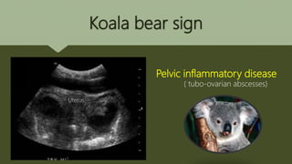 Koala bear sign
Pelvic inflammatory disease
( tubo-ovarian abscesses)
Uterus